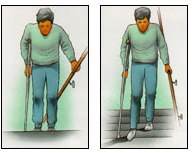 Post operative male patient climbing and decending a staircase on crutches